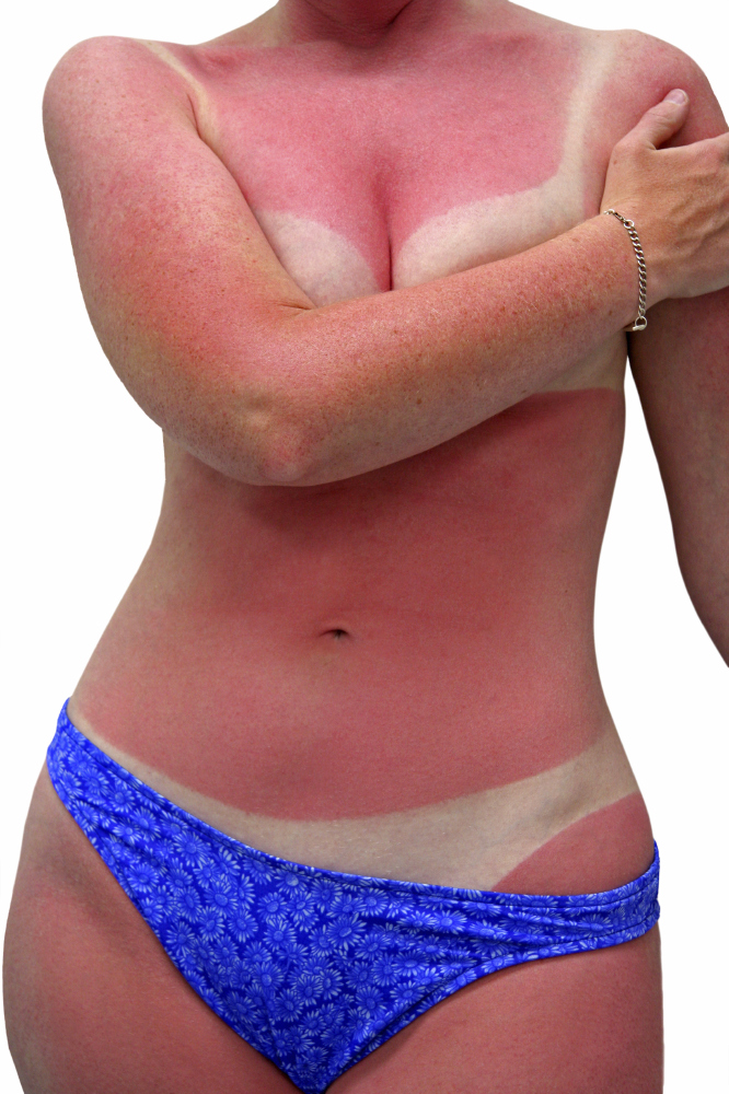 sunburn-skin-cancer-96326094.jpg