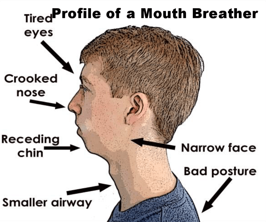 mouth-breathing2222orthotropics2222mike-mew2222mewing2222looks-theory2222facial-growth2222plastic-surgery2222cosmetic-surgery2222maxilla2222dentist.png