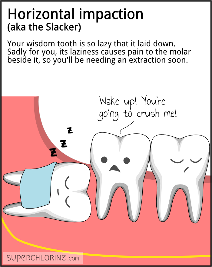 wisdom-teeth-types_horiz.png