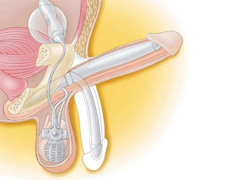 ams700-penile-implant.png