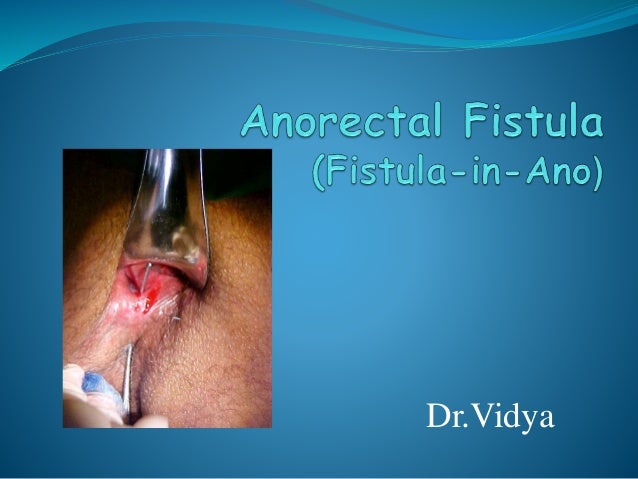 anorectal-fistula-1-638.jpg