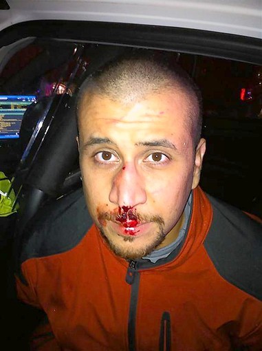 George-Zimmerman-bloody-nose.jpg